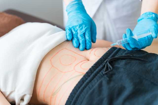 脂肪吸引の手術前のお腹の様子